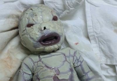 حادثة غريبة وعجيبة! أذهلت الأطباء والمختصون وجعلتهم في حيرة من أمرهم!