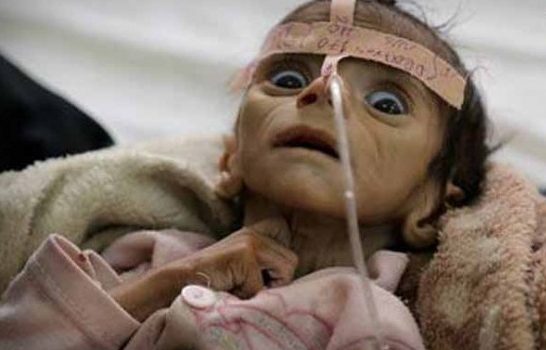 تفاقم الاوضاع الانسانية في اليمن… الصمت الدولي يحصد ارواح اليمنيين

