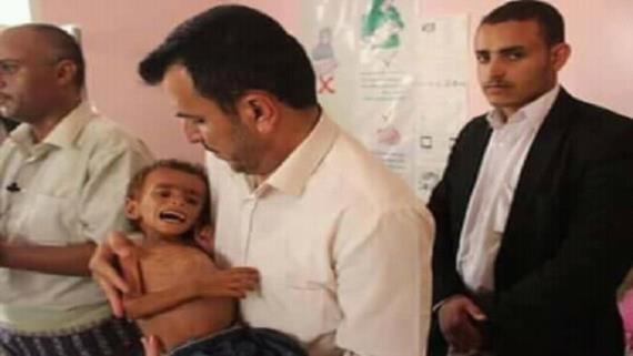 وزير الصحة: المنظمات الدولية لا تقوم بواجبها في اليمن