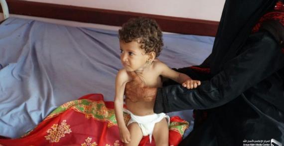 بسبب العدوان والحصار والمنظمات.. اليمن يفقد جيلًا بأكمله بسبب سوء التغذية